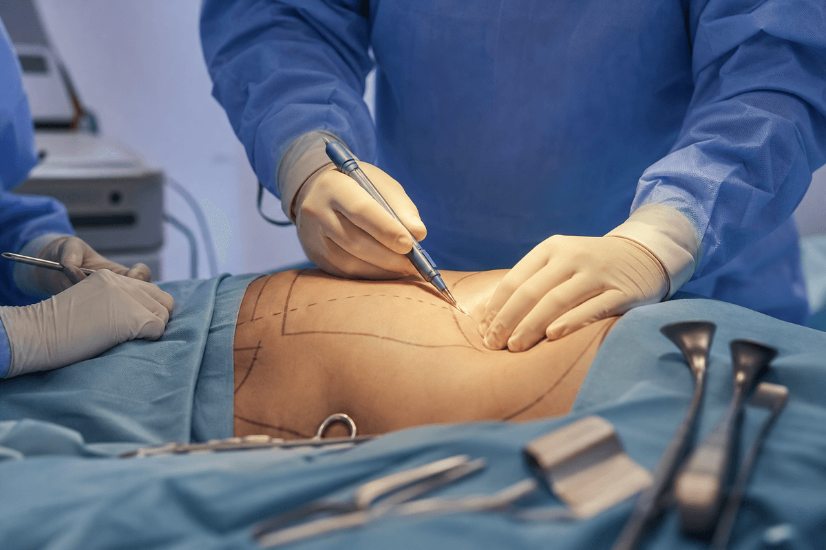 Tummy Tuck (Abdominoplasty)