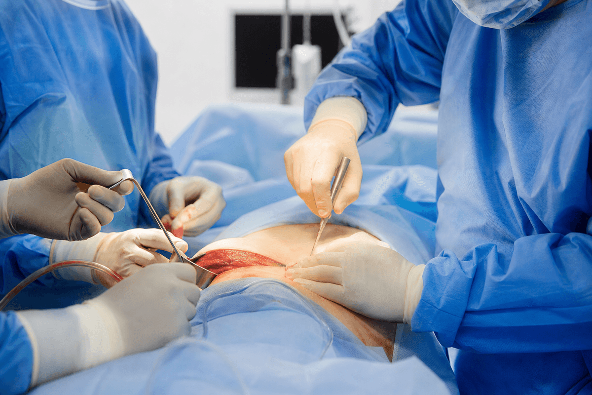 Breast Reduction Surgery