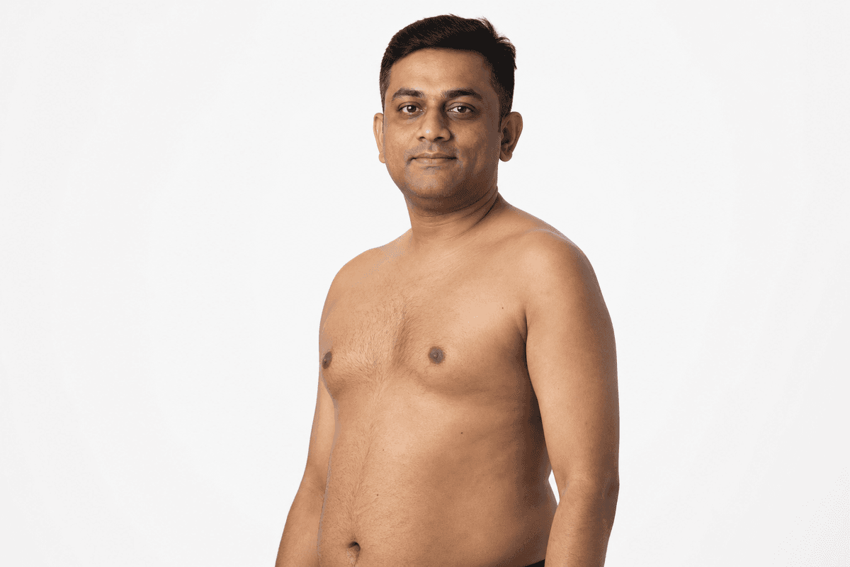 Gynecomastia