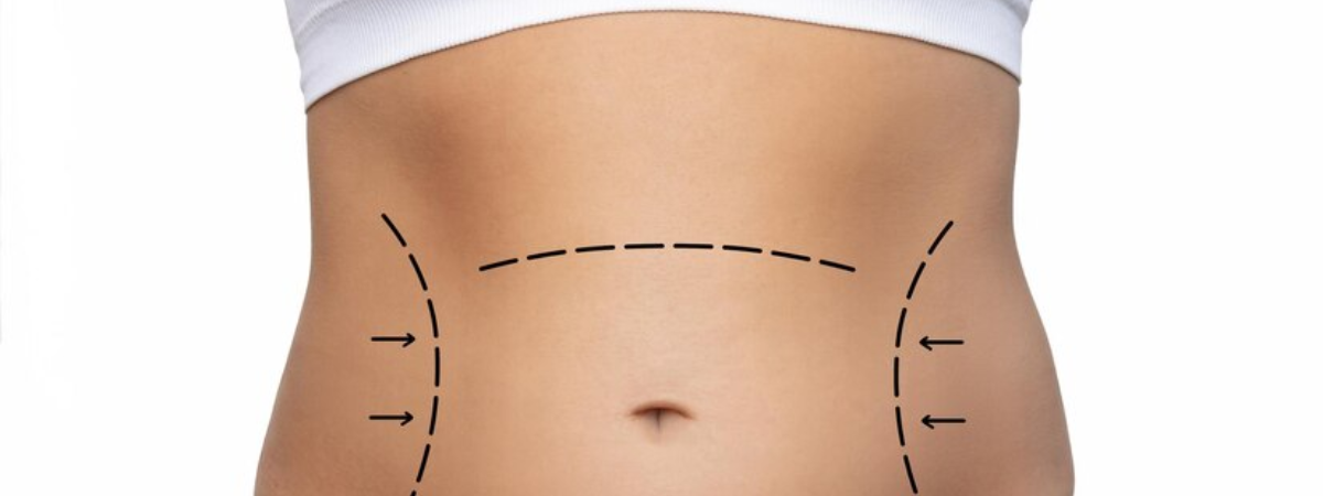 Tummy tuck