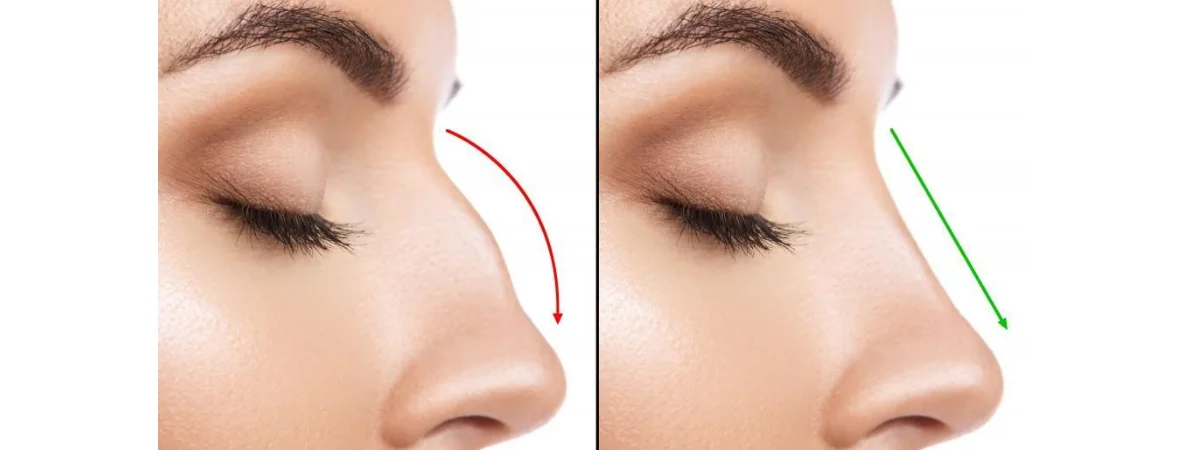 Blepharoplasty