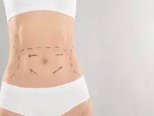 abdominoplasty-Hi-tech City