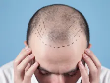 hair-transplantation-Hi-tech City