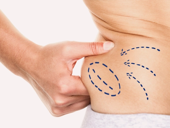 liposuction-treatment-near-hitechcity